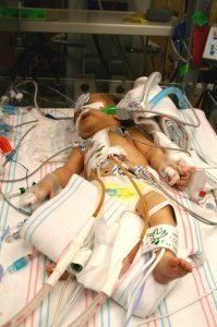 Jayden after his open-heart surgery